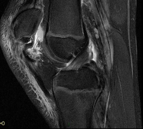 Figure 3 for case Patellar sleeve avulsion